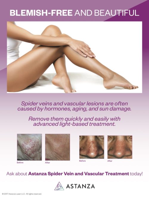 Astanza Vascular Lesion Poster