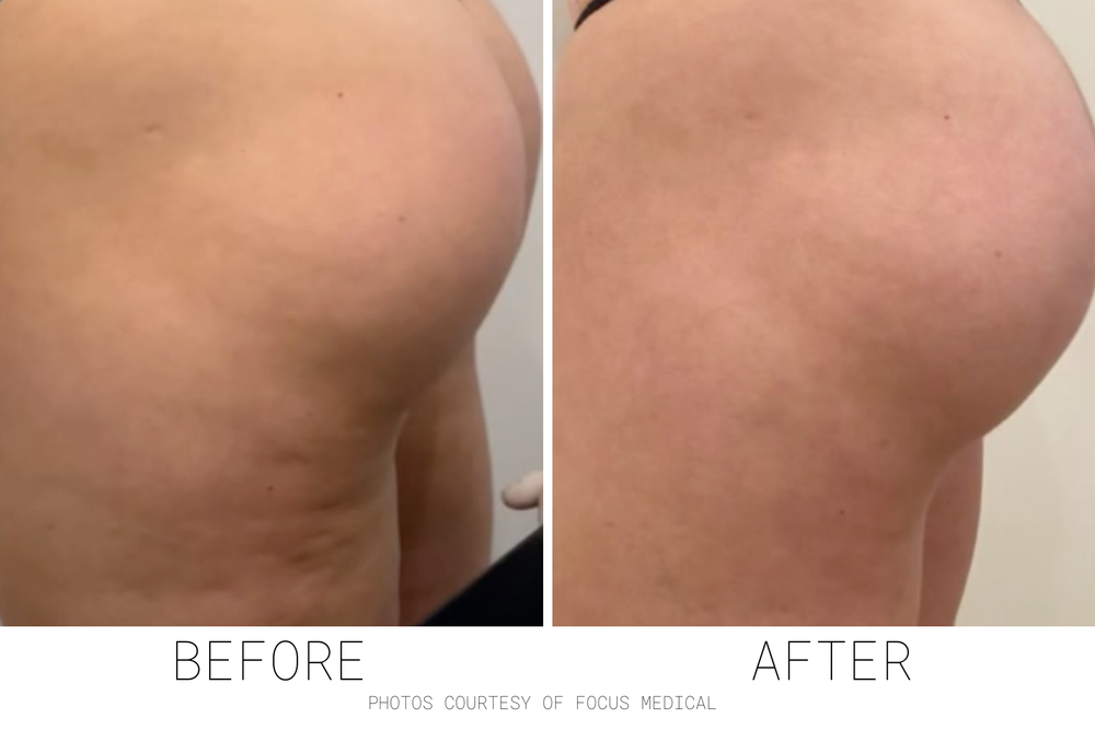 Carbon Wave Patch - Starter Kit Box of 25 Patches & Optic